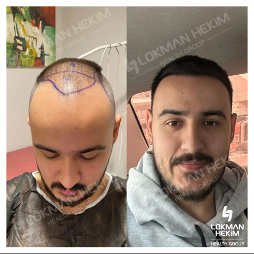 Photos Avant / Après 2